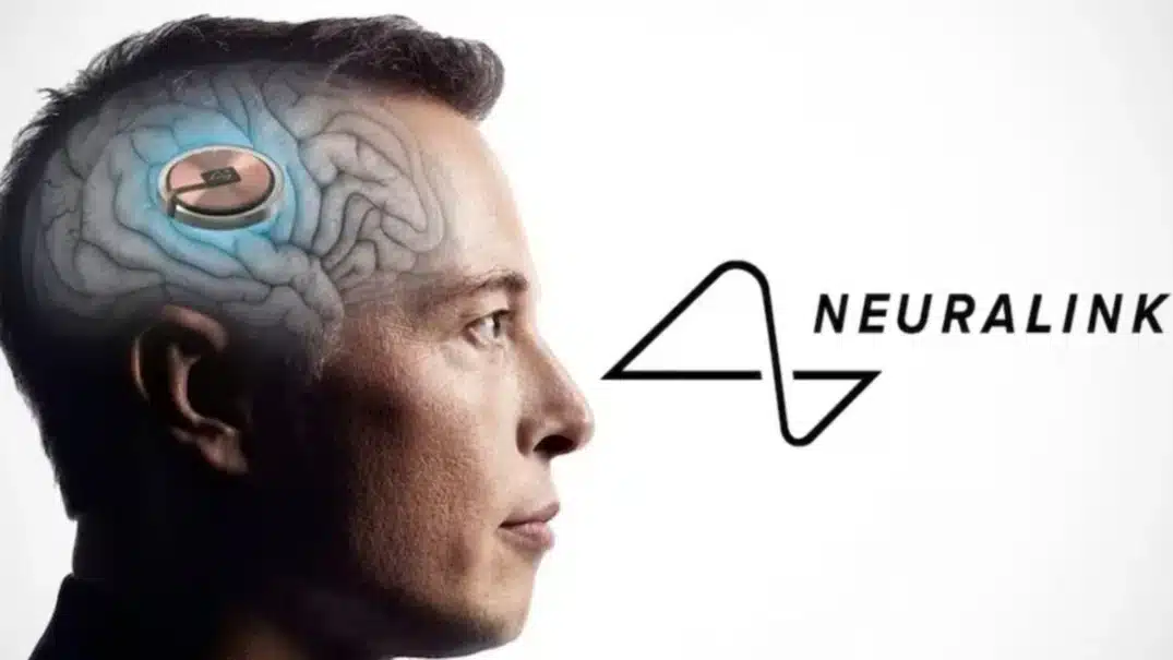 Neuralink Successfully Implants Second Brain Chip in Human Patient Alex