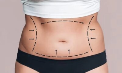 Can a Tummy Tuck Remove All Belly Fat?