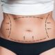 Can a Tummy Tuck Remove All Belly Fat?