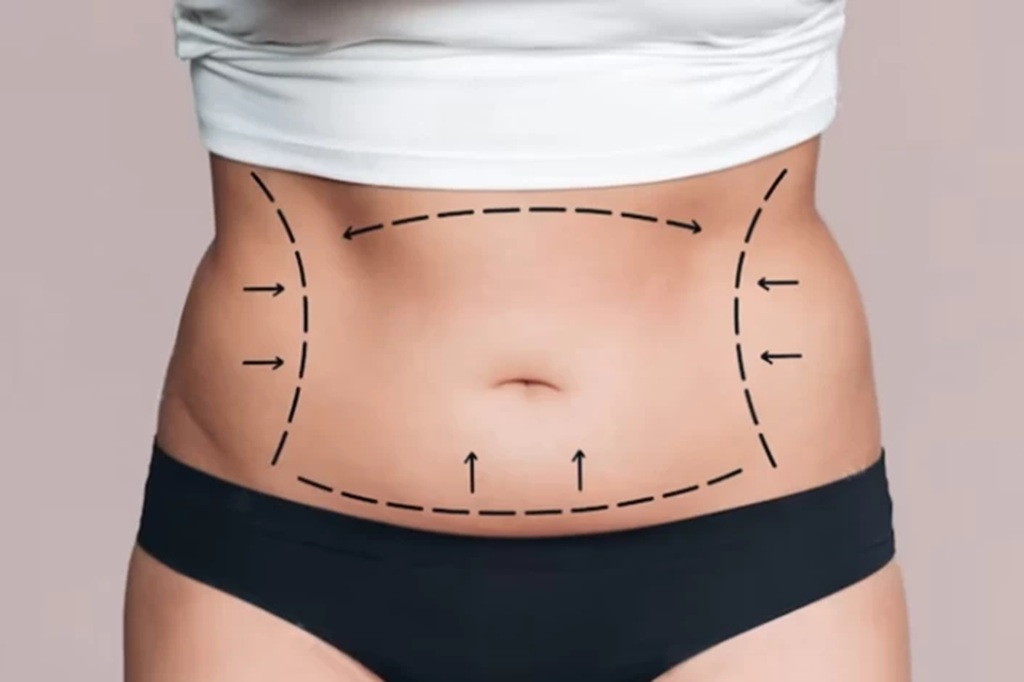 Can a Tummy Tuck Remove All Belly Fat?